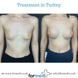 Breast Augmentation Turkiye