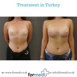 Breast Augmentation Turkiye
