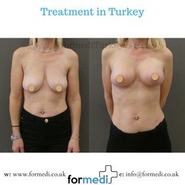 Breast Augmentation Turkiye
