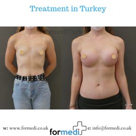 Breast Augmentation Turkiye