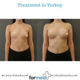 Breast Augmentation Turkiye