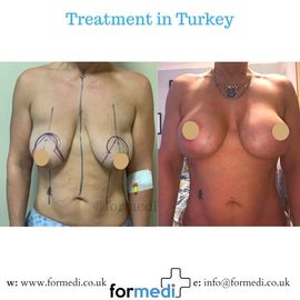 Breast Augmentation Turkiye