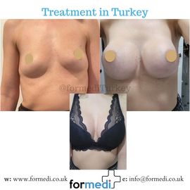 Breast Augmentation Turkiye