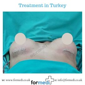 Breast Augmentation Turkiye