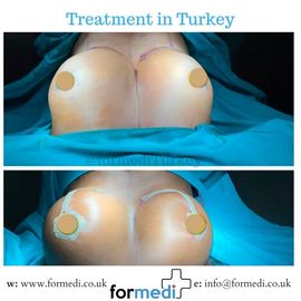 Breast Augmentation Turkiye