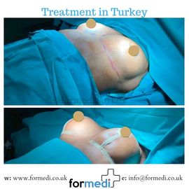 Breast Augmentation Turkiye