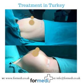 Breast Augmentation Turkiye