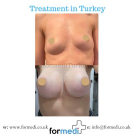 Breast Augmentation Turkiye