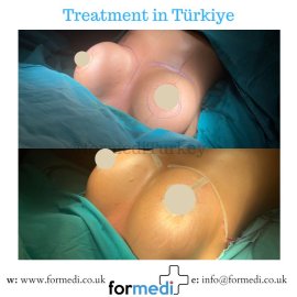 Breast Augmentation Turkiye