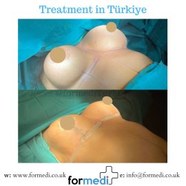 Breast Augmentation Turkiye