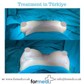 Breast Augmentation Turkiye