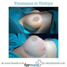 Breast Augmentation Turkiye