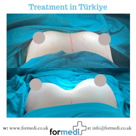 Breast Augmentation Turkiye