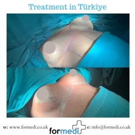 Breast Augmentation Turkiye