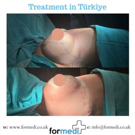 Breast Augmentation Turkiye