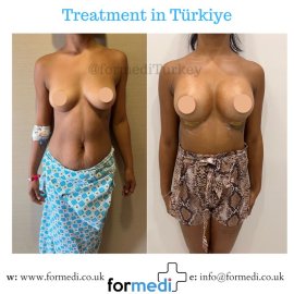 Breast Augmentation Turkiye