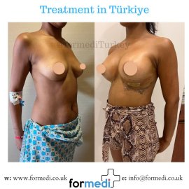 Breast Augmentation Turkiye