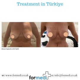 Breast Augmentation Turkiye