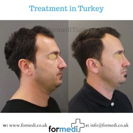 Rhinoplasty Turkey