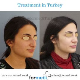 Rhinoplasty Turkey