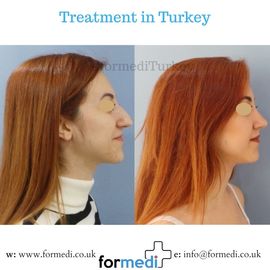 Rhinoplasty Turkey