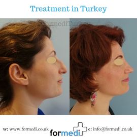 Rhinoplasty Turkey