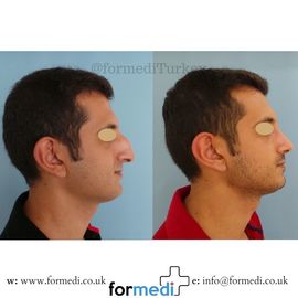 Rhinoplasty Turkey