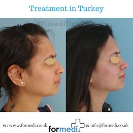 Rhinoplasty Turkey
