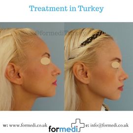 Rhinoplasty Turkey