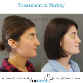 Rhinoplasty Turkey