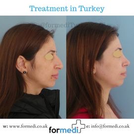 Rhinoplasty Turkey