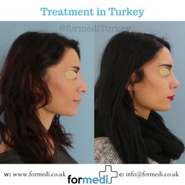Rhinoplasty Turkey