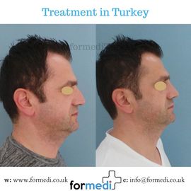 Rhinoplasty Turkey