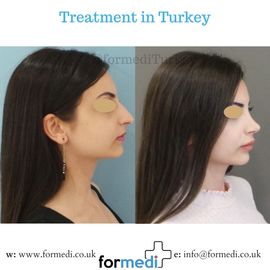 Rhinoplasty Turkey