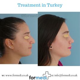 Rhinoplasty Turkey