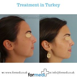 Rhinoplasty Turkey