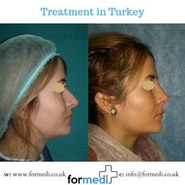 Rhinoplasty Turkey