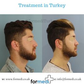 Rhinoplasty Turkey