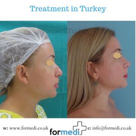 Rhinoplasty Turkey
