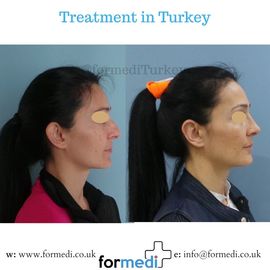 Rhinoplasty Turkey