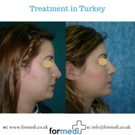 Rhinoplasty Turkey