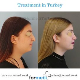 Rhinoplasty Turkey
