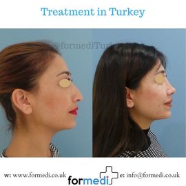 Rhinoplasty Turkey