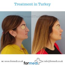 Rhinoplasty Turkey