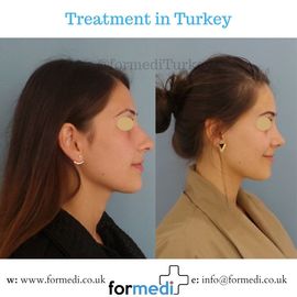 Rhinoplasty Turkey
