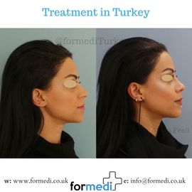 Rhinoplasty Turkey