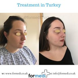 Rhinoplasty Turkey