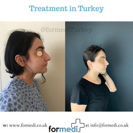 Rhinoplasty Turkey