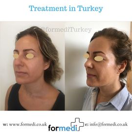 Rhinoplasty Turkey