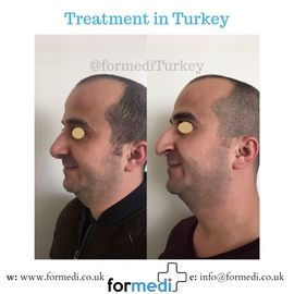 Rhinoplasty Turkey